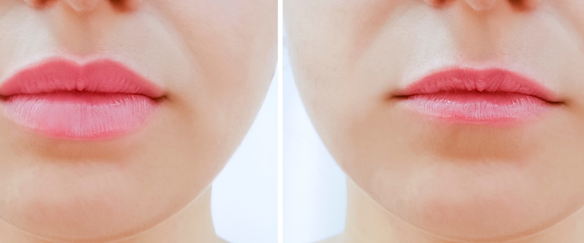 10 Best Lip Injections in New York Neighborhoods