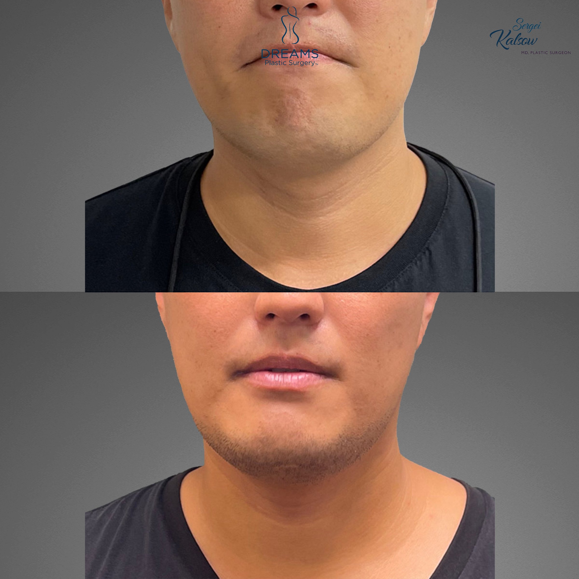 10 Chin Lipo in New York Neighborhoods