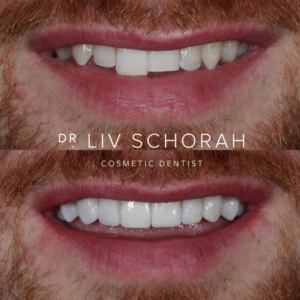 10 Composite Bonding in New York Neighborhoods