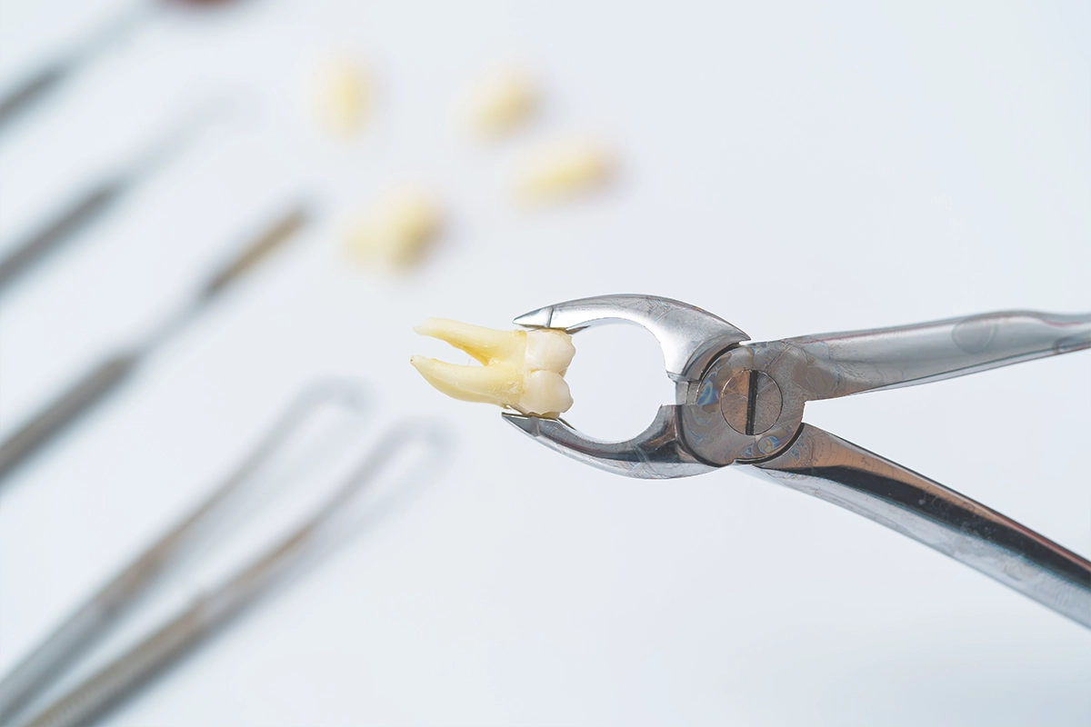 10 Dental Extractions in New York Neighborhoods