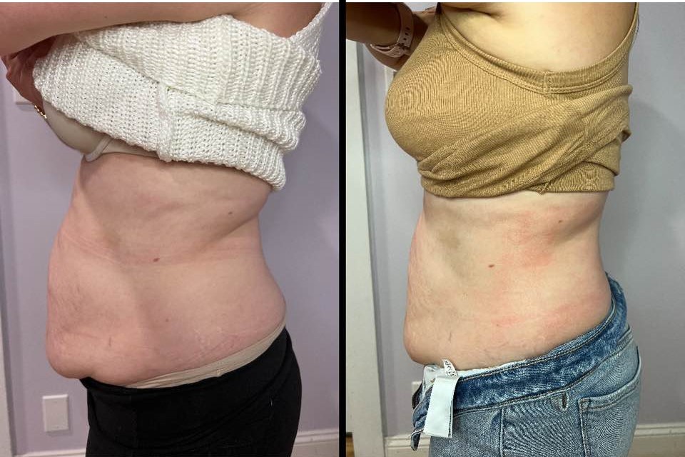 10 Cryo Slimming in New York Neighborhoods