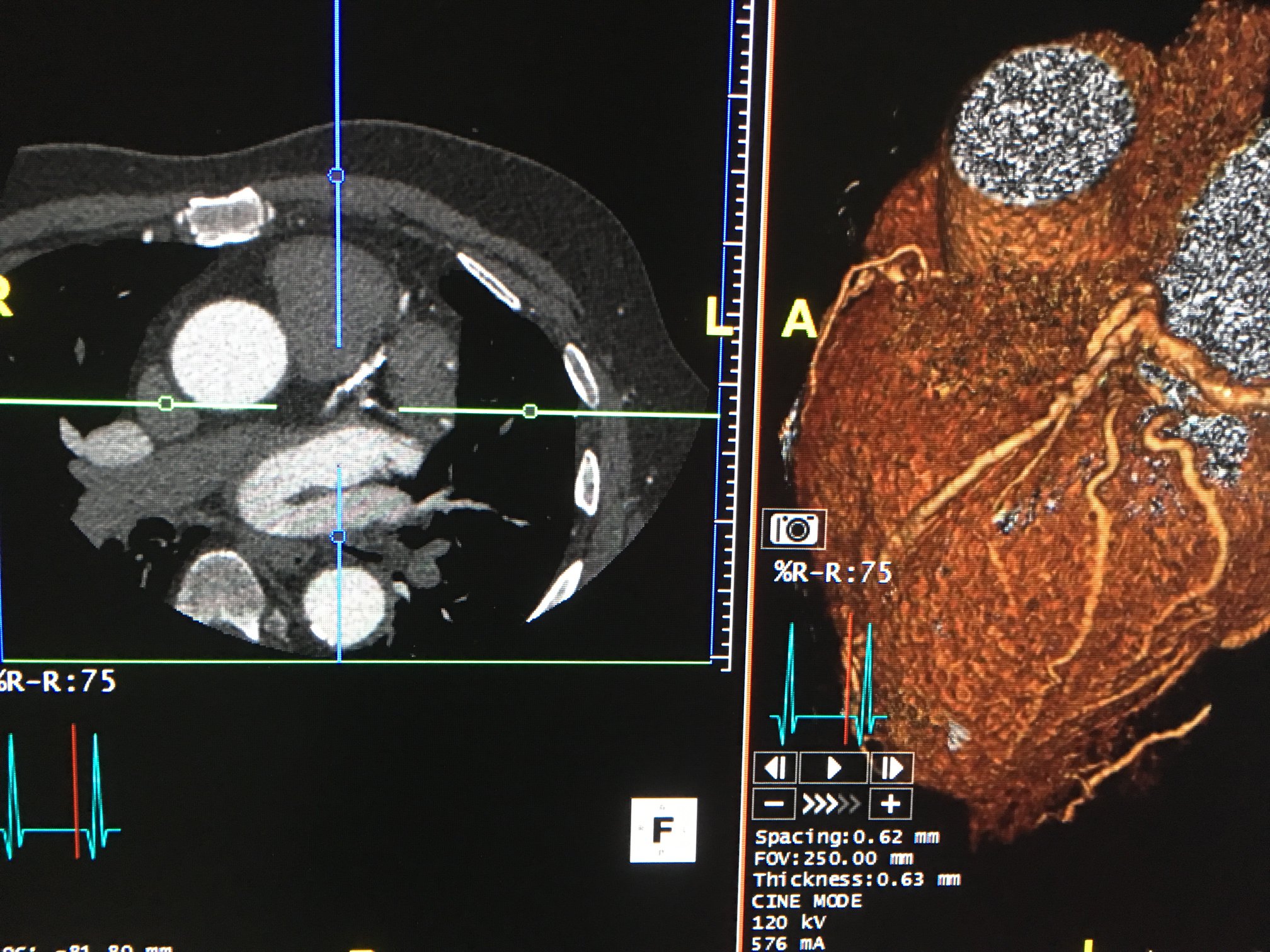 10 Calcium Score Test in New York Neighborhoods