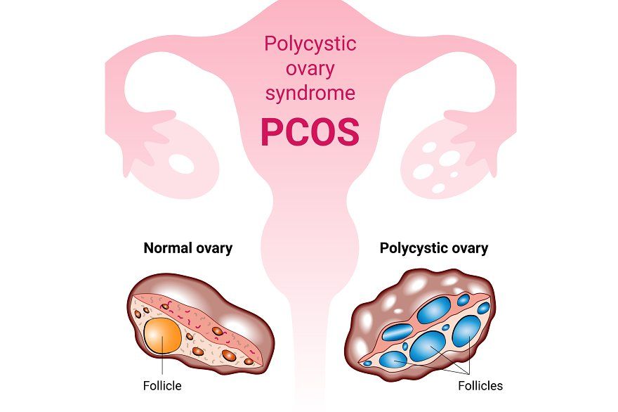10 Pcos Specialist in New York Neighborhoods