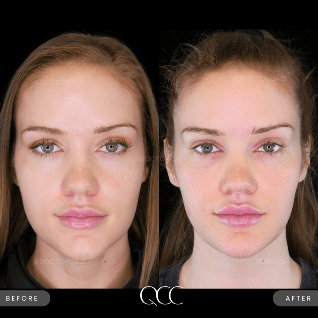 10 Masseter Botox in New York Neighborhoods