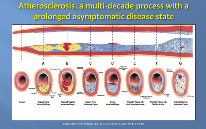 10 Coronary Calcium Scan in New York Neighborhoods