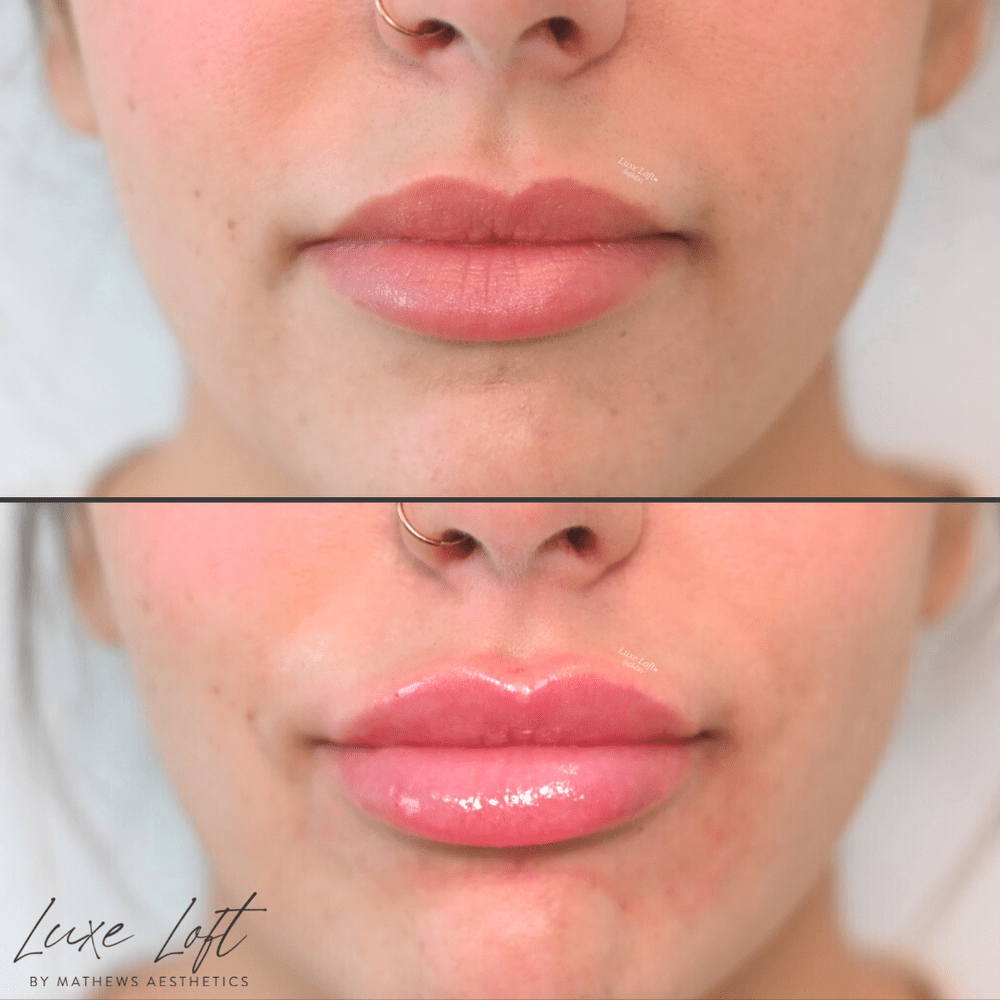 10 Lip Filler Specials in New York Neighborhoods