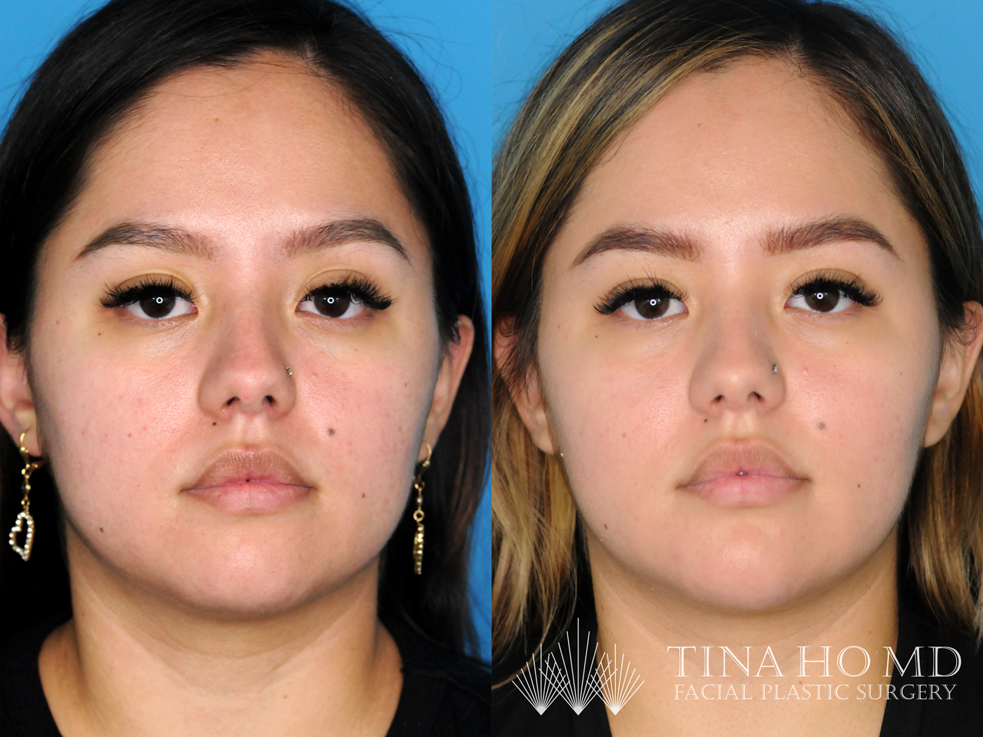 10 Cost Of Blepharoplasty in New York Neighborhoods