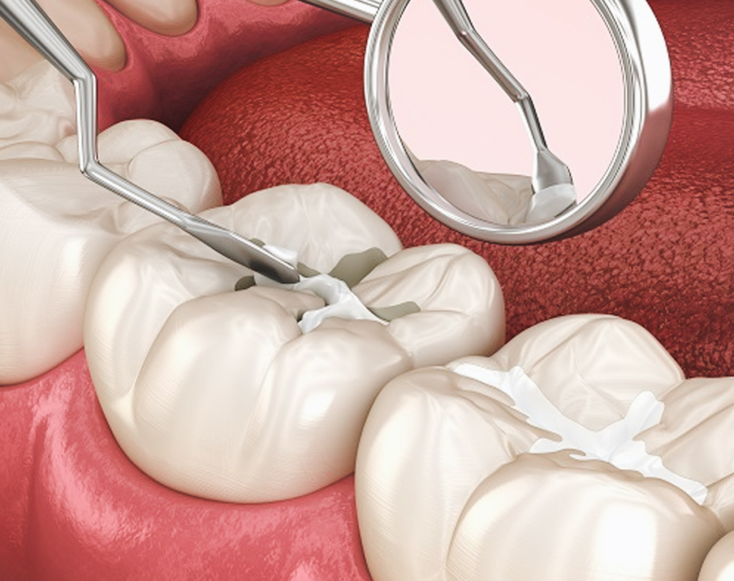 10 Dental Sealants in New York Neighborhoods