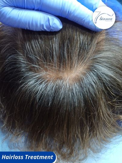 10 Hair Loss Treatment in New York Neighborhoods