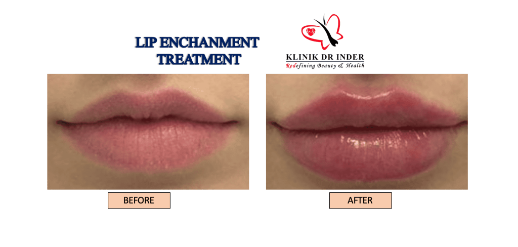 10 Lip Enhancement in New York Neighborhoods
