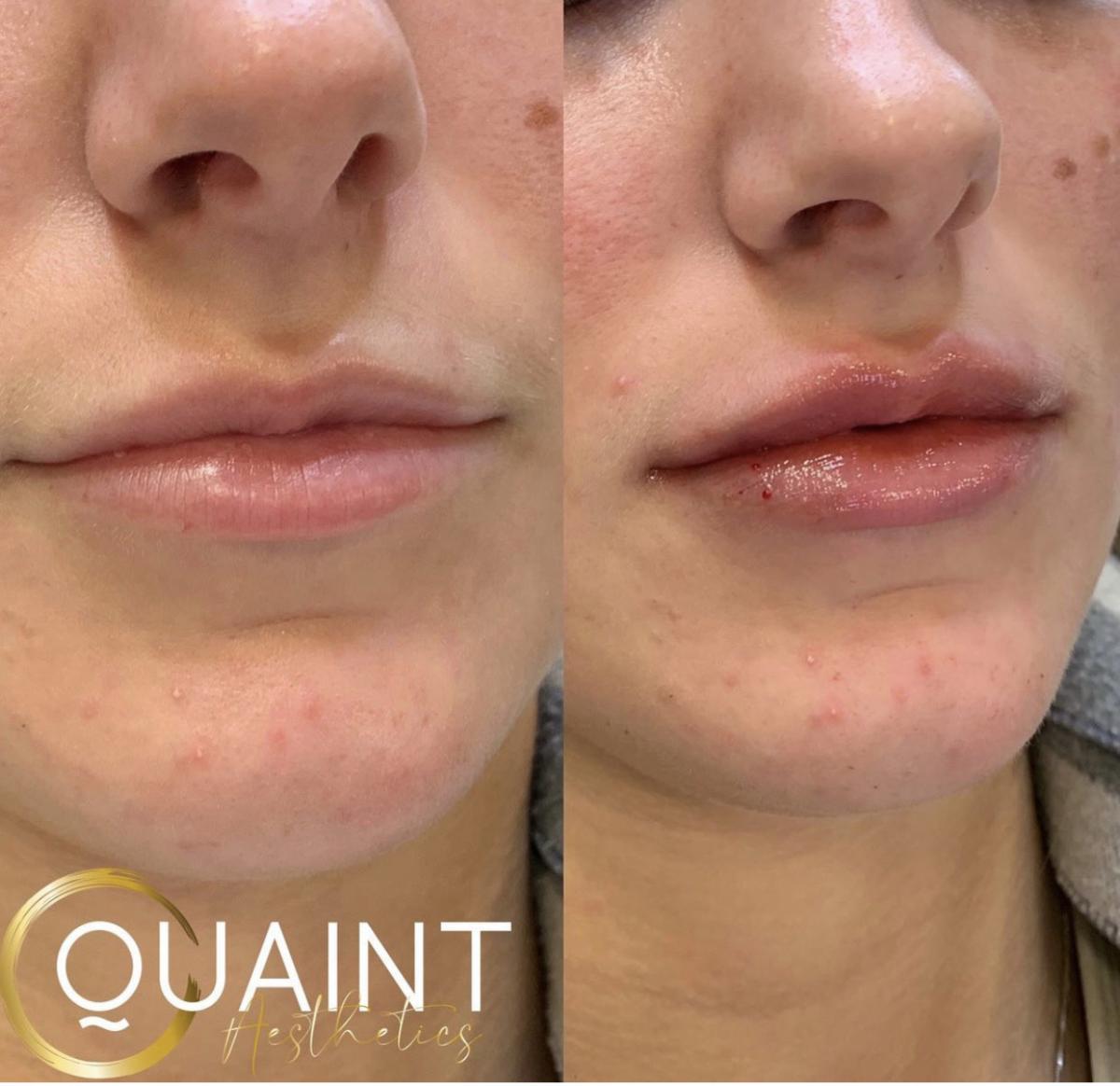 10 Lip Fillers in Los Angeles Neighborhoods