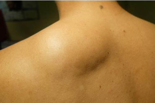 10 Lipoma Removal in New York Neighborhoods