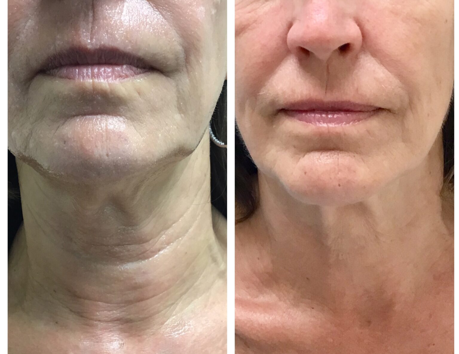 10 Microneedling in Los Angeles Neighborhoods