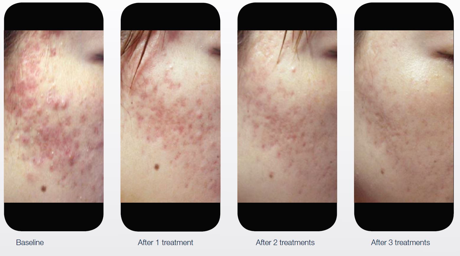 10 Acne Scar Treatment in New York Neighborhoods
