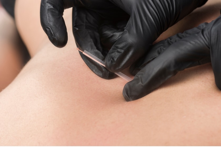 10 Dry Needling in New York Neighborhoods