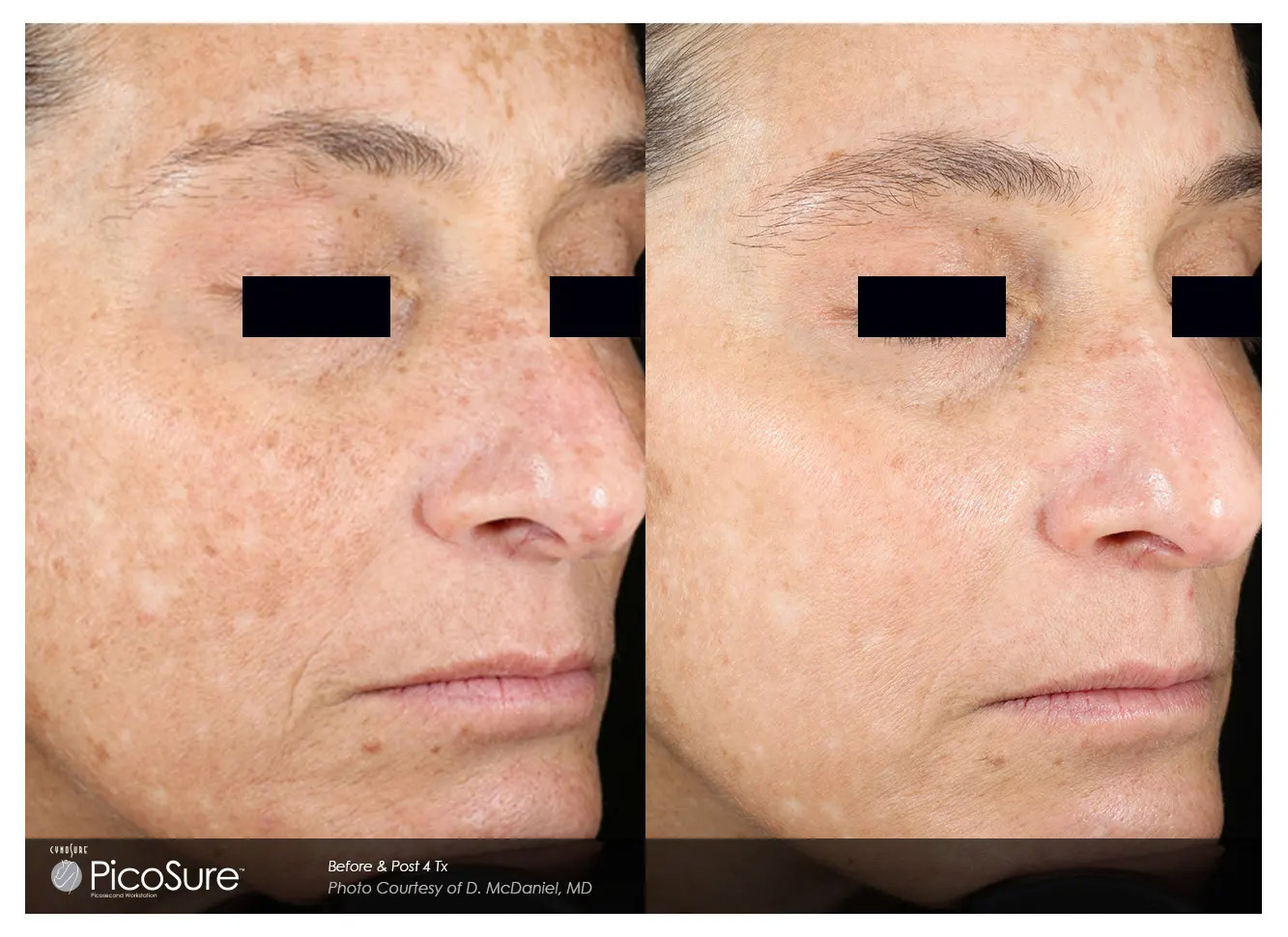 10 Picosure Laser in New York Neighborhoods