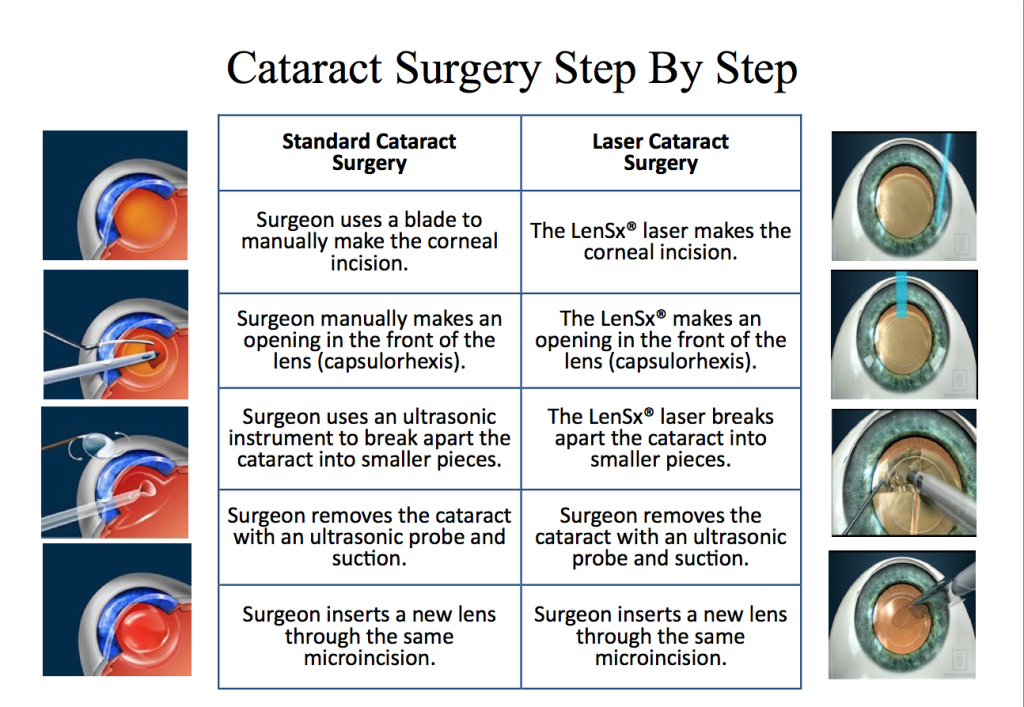 10 Cataracts Surgery in New York Neighborhoods