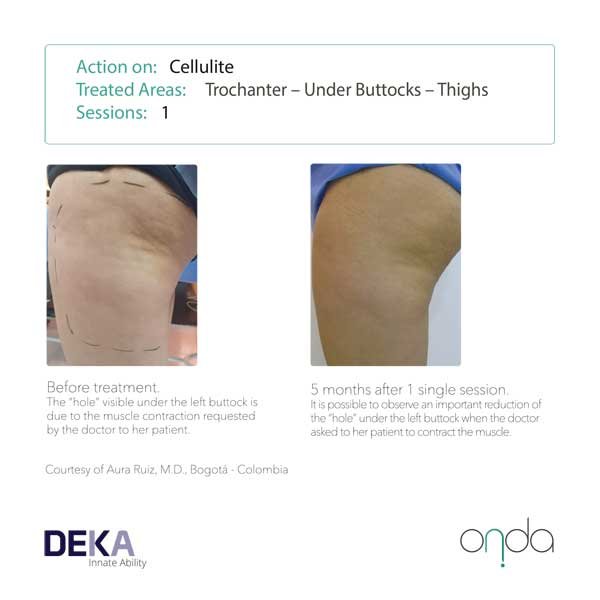 10 Cellulite Treatment in New York Neighborhoods
