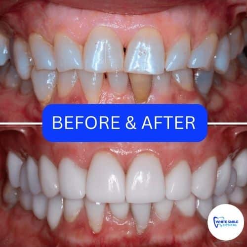 10 Composite Veneers in New York Neighborhoods