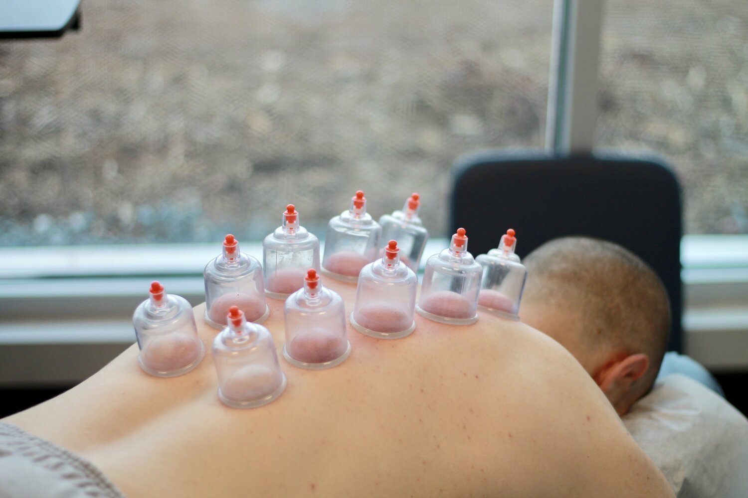 10 Cupping Therapy in Los Angeles Neighborhoods