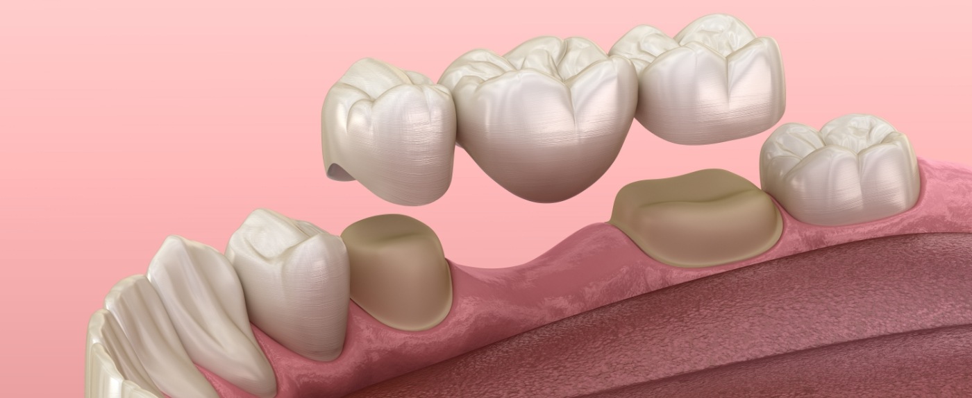10 Dental Bridges in Los Angeles Neighborhoods