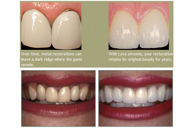 10 Dental Crowns in New York Neighborhoods