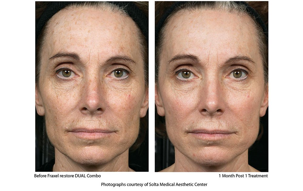 10 Fraxel Laser in New York Neighborhoods