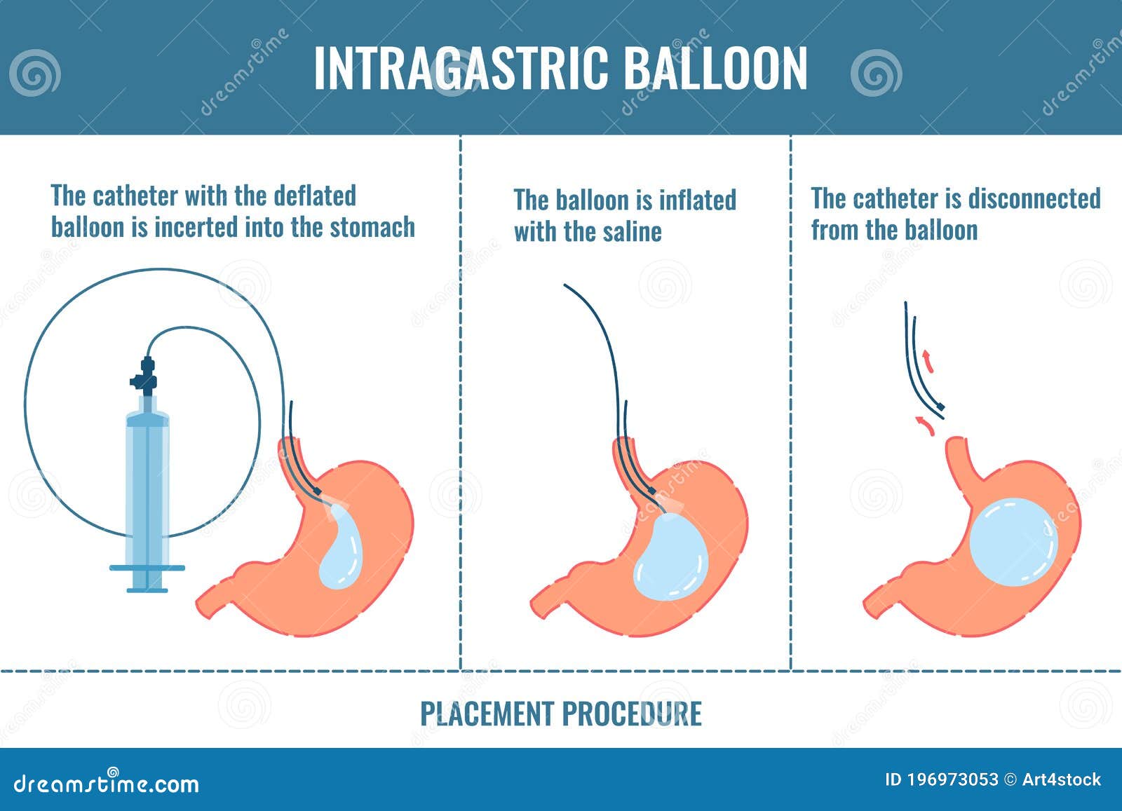 10 Gastric Balloon in New York Neighborhoods