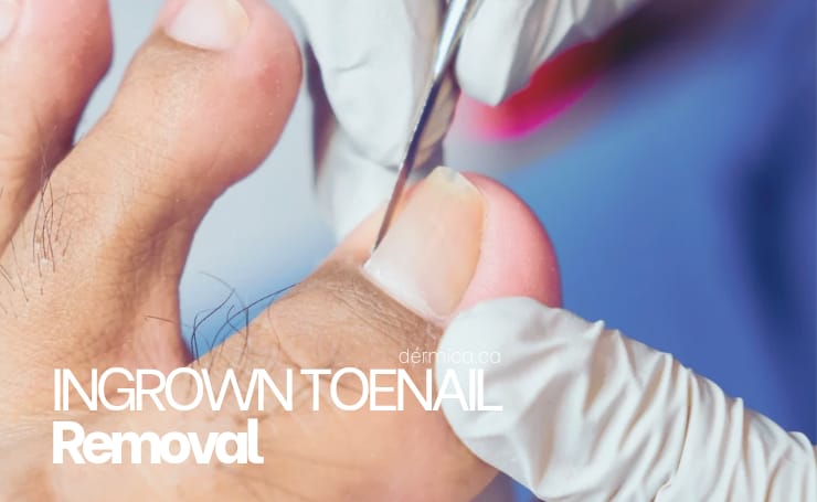 10 Ingrown Toenail Removal in New York Neighborhoods