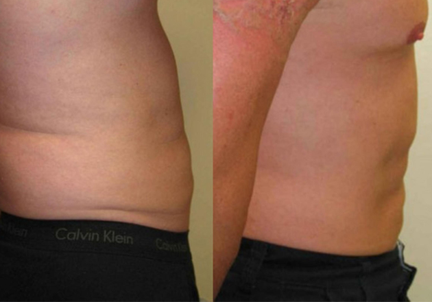 10 Liposuction in New York Neighborhoods