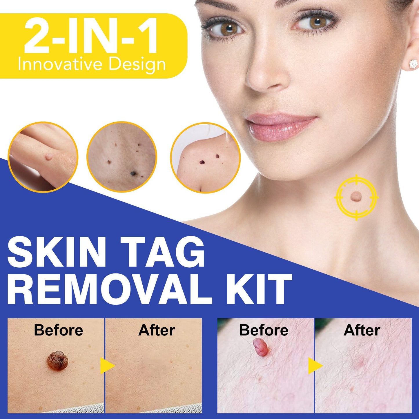 10 Skin Tag Removal in New York Neighborhoods