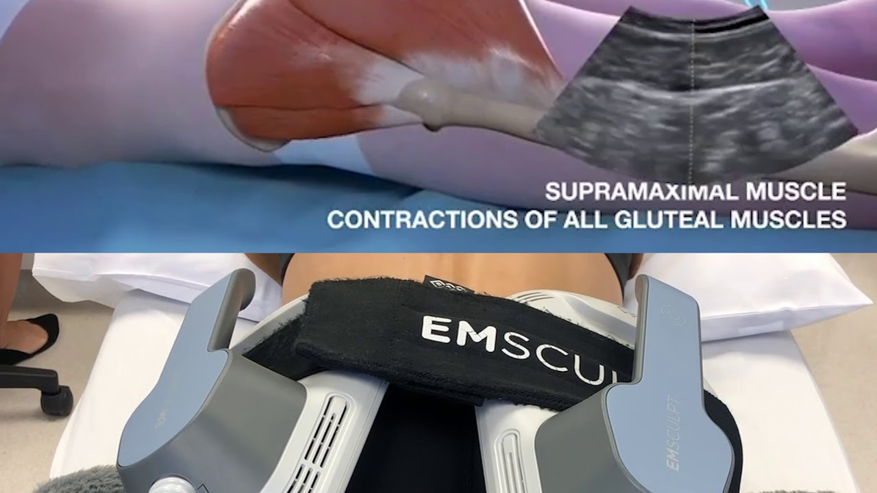 10 Emsculpt in New York Neighborhoods