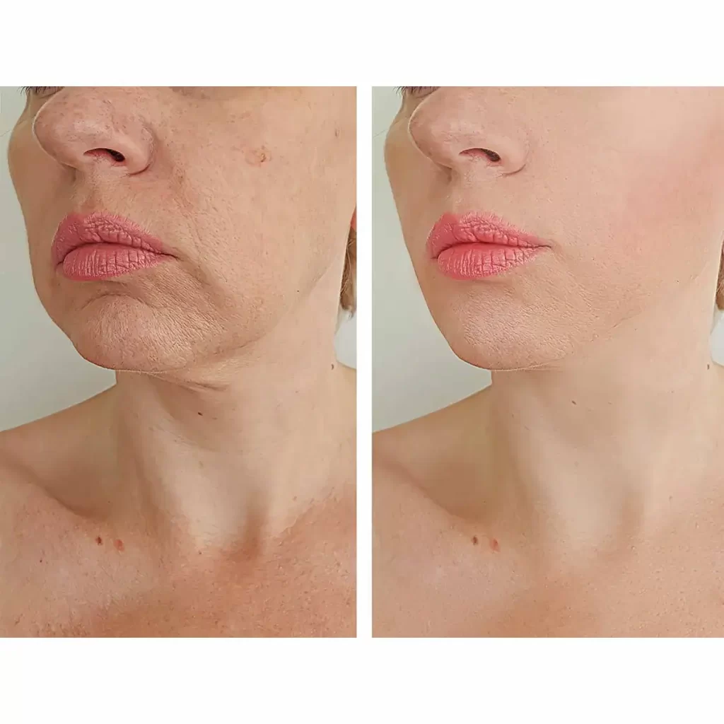 10 Microneedling Cheap in New York Neighborhoods