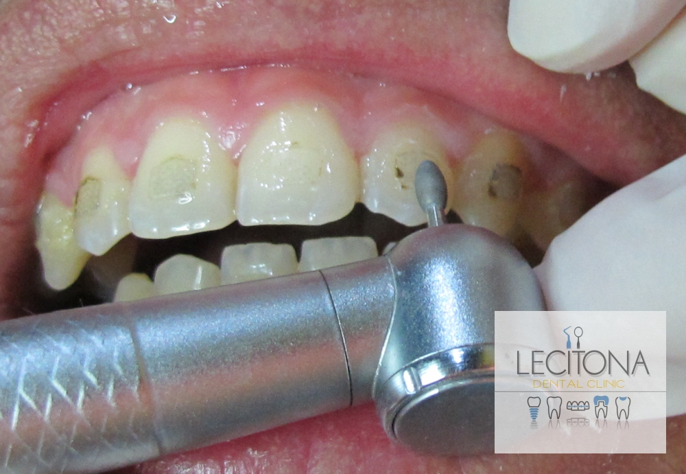 10 Braces Removal in New York Neighborhoods