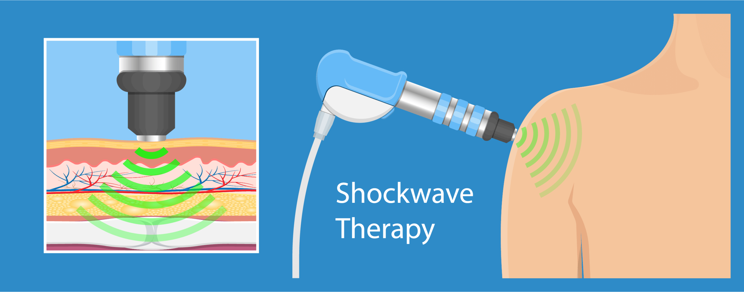 10 Shockwave Therapy in New York Neighborhoods