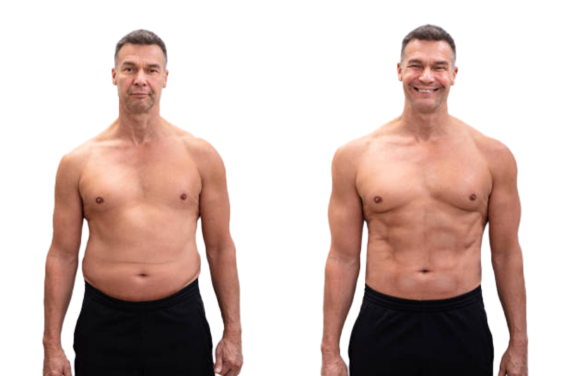 10 Tummy Tuck in New York Neighborhoods