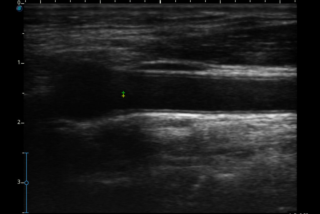 10 Cimt Test in New York Neighborhoods