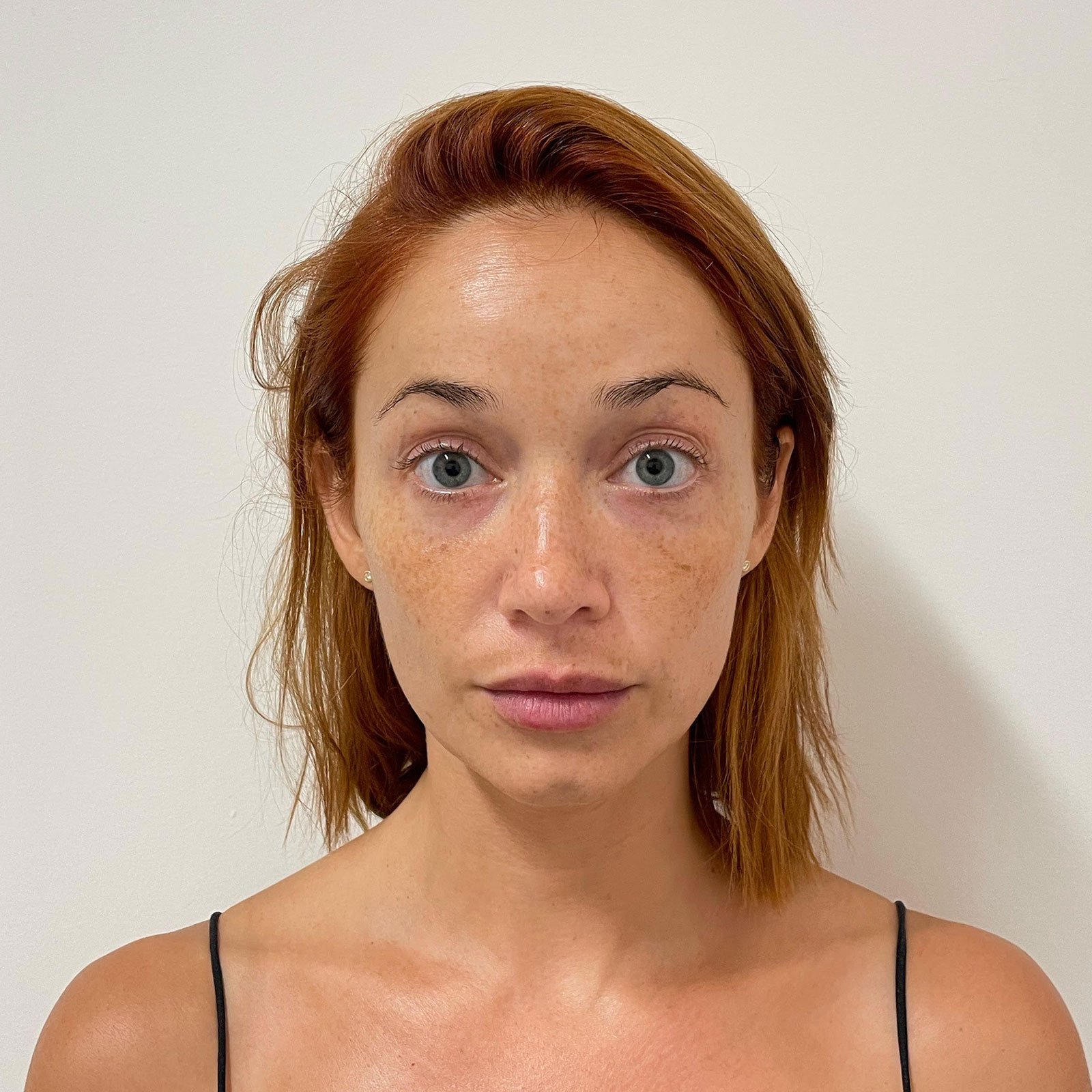 10 Under Eye Fillers in New York Neighborhoods