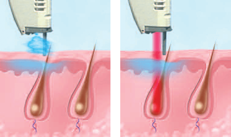 10 Vbeam Laser in New York Neighborhoods