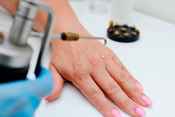 10 Wart Removal in New York Neighborhoods