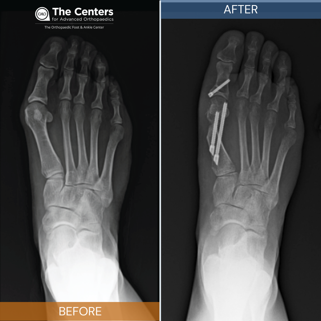 10 Bunion Surgery in New York Neighborhoods