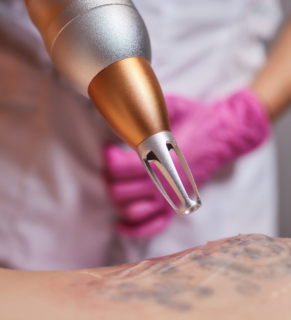 10 Laser Tattoo Removal in New York Neighborhoods